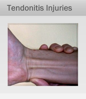 Tendonitis, Tendinosis Treatment Marin, San Francisco Tendonitis, Tendinosis Treatment Therapy in Marin, San Francisco