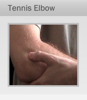 Tennis Elbow Treatment Therapy Marin, San Francisco Tennis Elbow Treatment Therapy in Marin, San Francisco