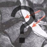 MRI of Low Back MRI of Low Back Showing Herniated Discs